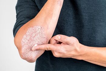 Applicare la crema sulla zona della pelle danneggiata dalla psoriasi