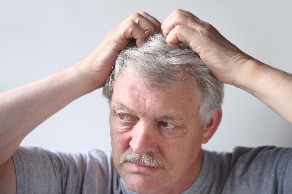 sintomi della psoriasi sulla testa