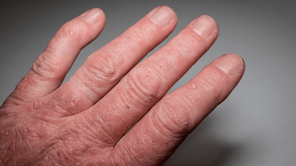 artrite psoriasica alle mani