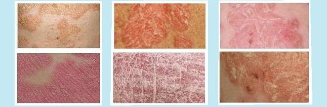 Eruzioni cutanee caratteristiche di diversi tipi di psoriasi