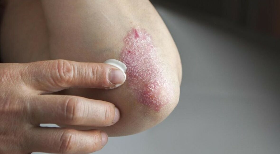 Psoriasi che colpisce la pelle, il cui trattamento prevede l'uso di unguenti
