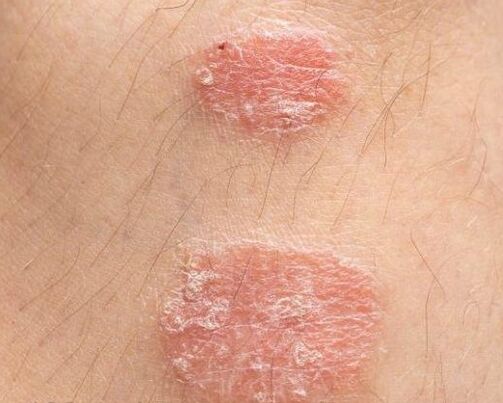 Aspetto delle placche psoriasiche