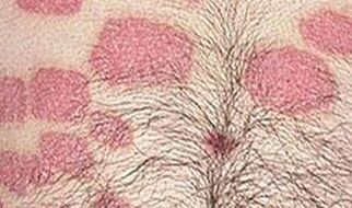 Più formazioni rosa sull'addome