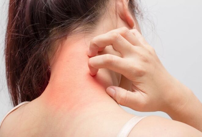 Il prurito è una delle cause della psoriasi