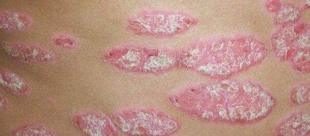 La fase progressiva della psoriasi
