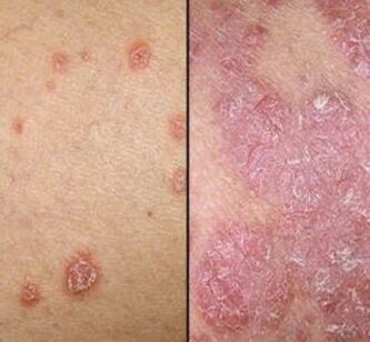 Placche psoriatiche