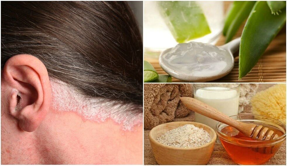 Trattamento della psoriasi con rimedi popolari