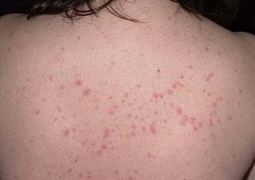 La fase iniziale della psoriasi