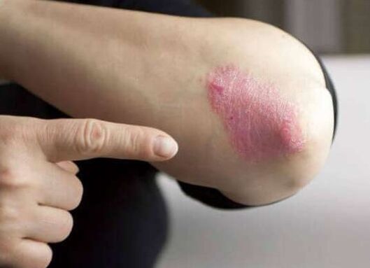 La fase stazionaria della psoriasi