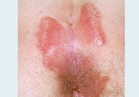Close -spinning Psoriasi