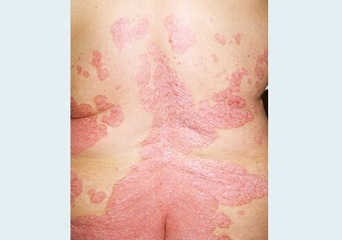 Psoriasi della parte posteriore