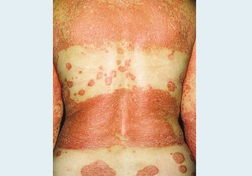 Psoriasi genitale