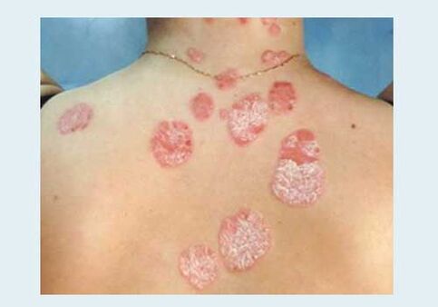 Psoriasi ordinaria