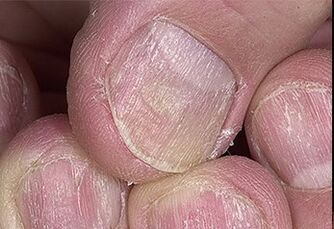 Psoriasi delle unghie