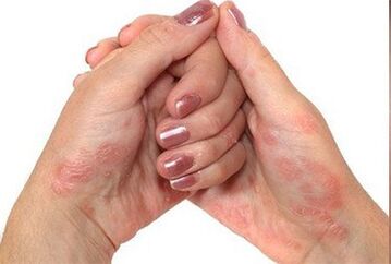 Psoriasi nelle mani