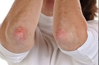 Psoriasi sui gomiti
