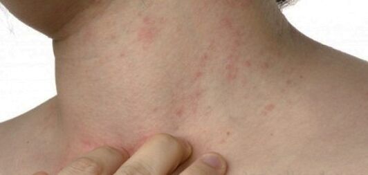 Psoriasi sul collo
