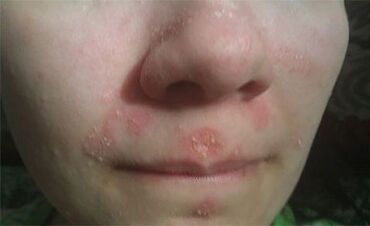 Psoriasi sul viso