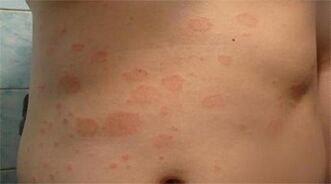 Psoriasi sullo stomaco