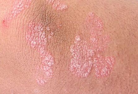 psoriasi