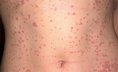 Psoriasi sul corpo