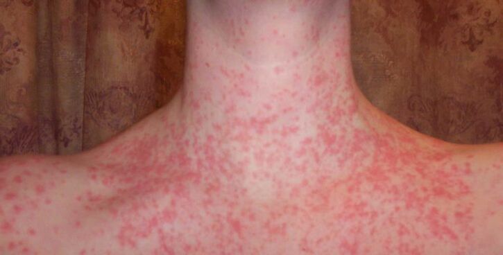 Psoriasi sul corpo