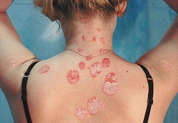 Psoriasi sul retro