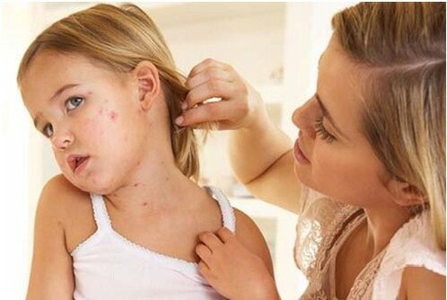 Foto della fase iniziale della psoriasi