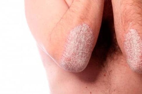 Psoriasi sui gomiti