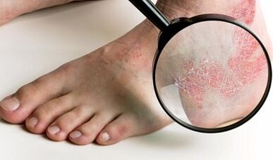 opzioni di trattamento della psoriasi