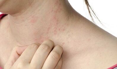 trattamento della psoriasi in fase avanzata