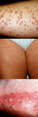 Psoriasi sulle gambe