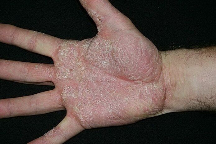psoriasi delle palme e dei piedi