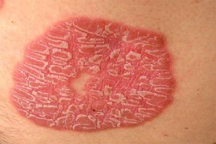 psoriasi pustolosa