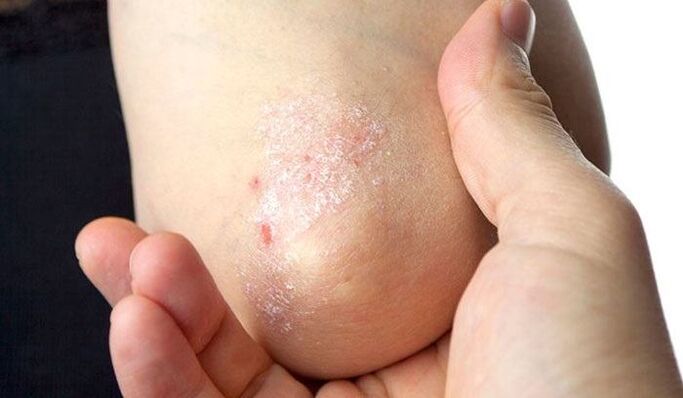 sintomi della psoriasi nella fase iniziale