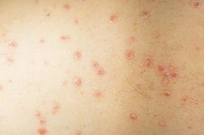 sintomi della psoriasi spot