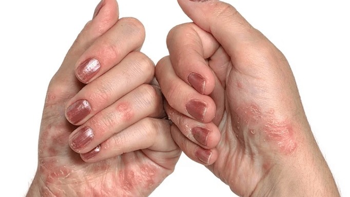 fase iniziale della psoriasi