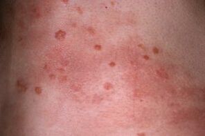 foto della psoriasi sulla pelle