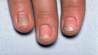 cause della psoriasi sulle unghie