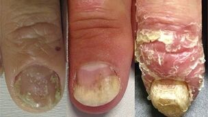 fasi di sviluppo della psoriasi delle unghie